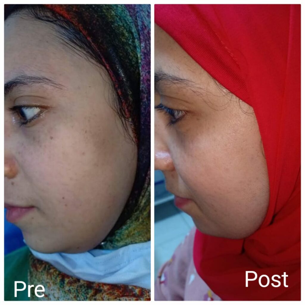 Before and after using the laser